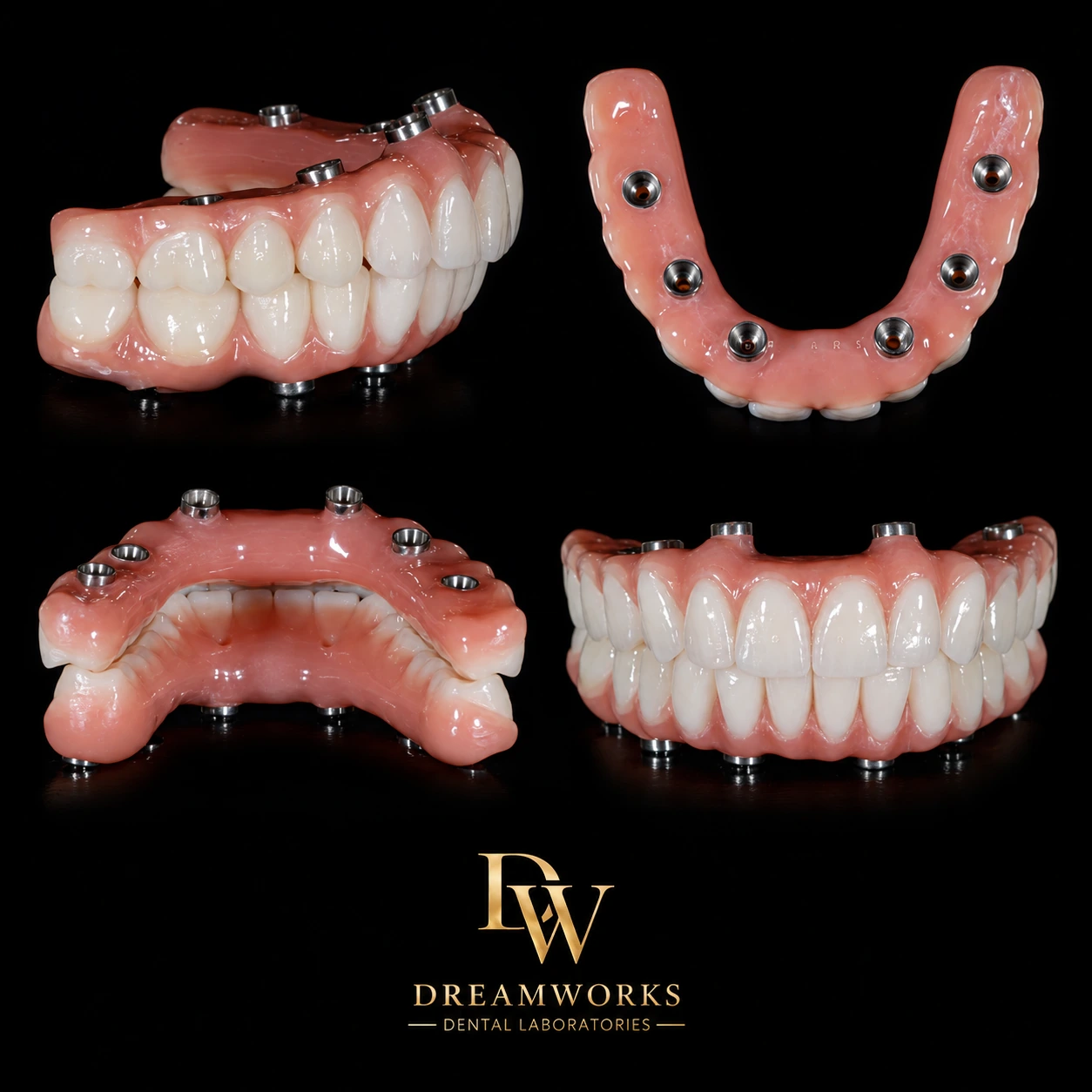 Screw-retained full arch fixed provisional from Dreamworks Dental Lab